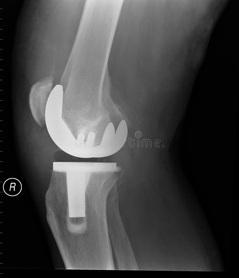 Boční x-ray ukazuje právo totální náhrady kolenního kloubu.