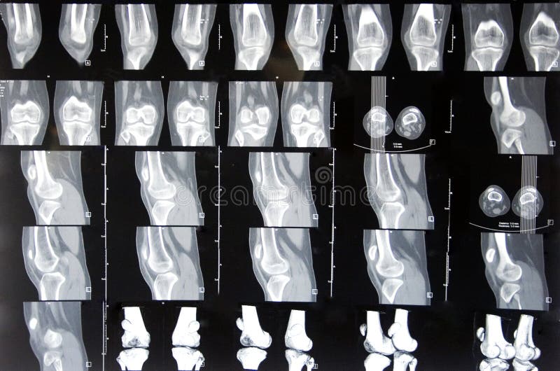 Knie MRI stock foto's Knie MRI stock foto's