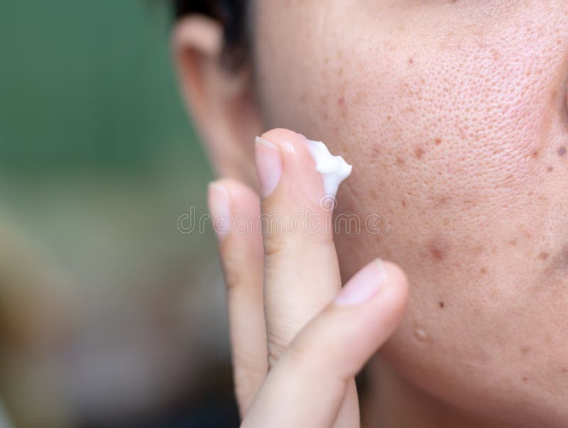 Kobieta stosuje śmietankę na twarzy która problemową problemayczną skórę, trądzik blizny, wazeliniarska skóra, por, ciemni punkty