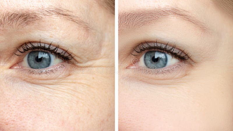 Kobiety twarz, oko marszczy przed i po traktowaniem - rezultat odmłodnieć cosmetological procedury biorevitalization