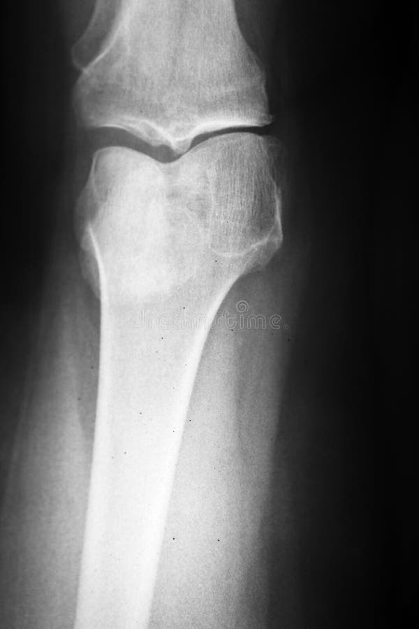 Kolanowy xray obraz royalty free