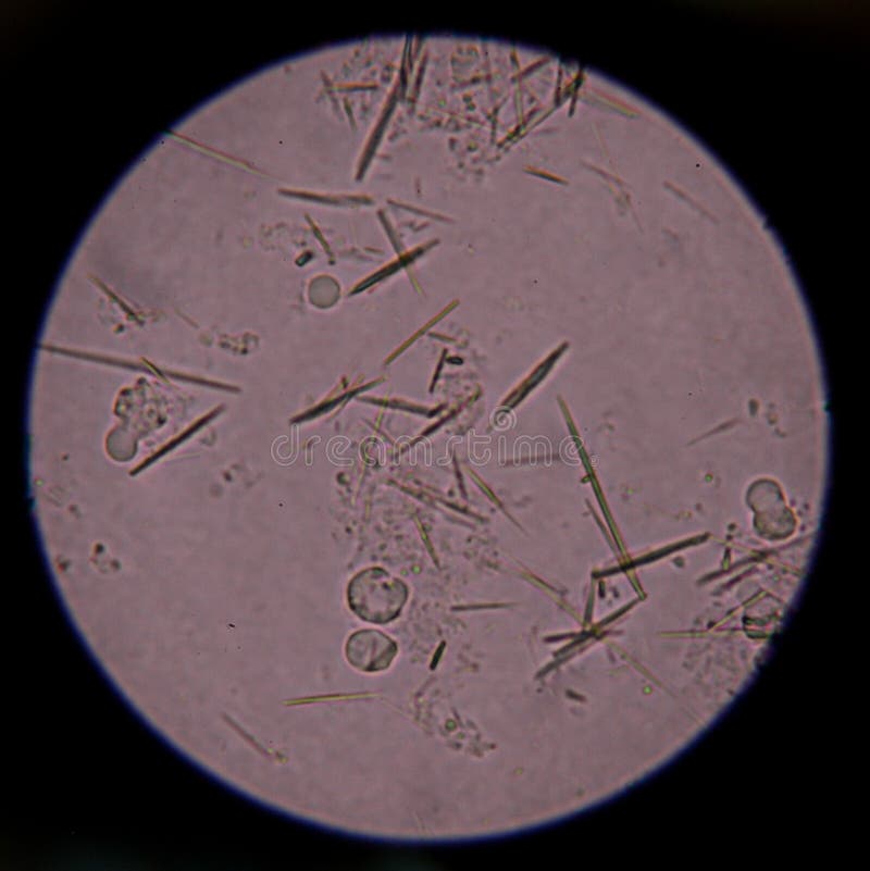 Harnsäure Im Urinsediment Harnsäure Wird Vom Natürlichen B Gemacht