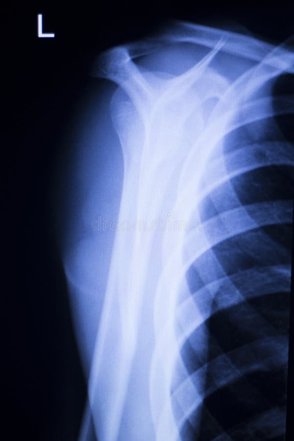 Spine vertebra ribs back injury vertebral column medical x-ray test scan image. Spine vertebra ribs back injury vertebral column medical x-ray test scan image.