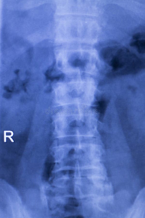 Spine vertebra back injury vertebral column medical x-ray test scan image. Spine vertebra back injury vertebral column medical x-ray test scan image.