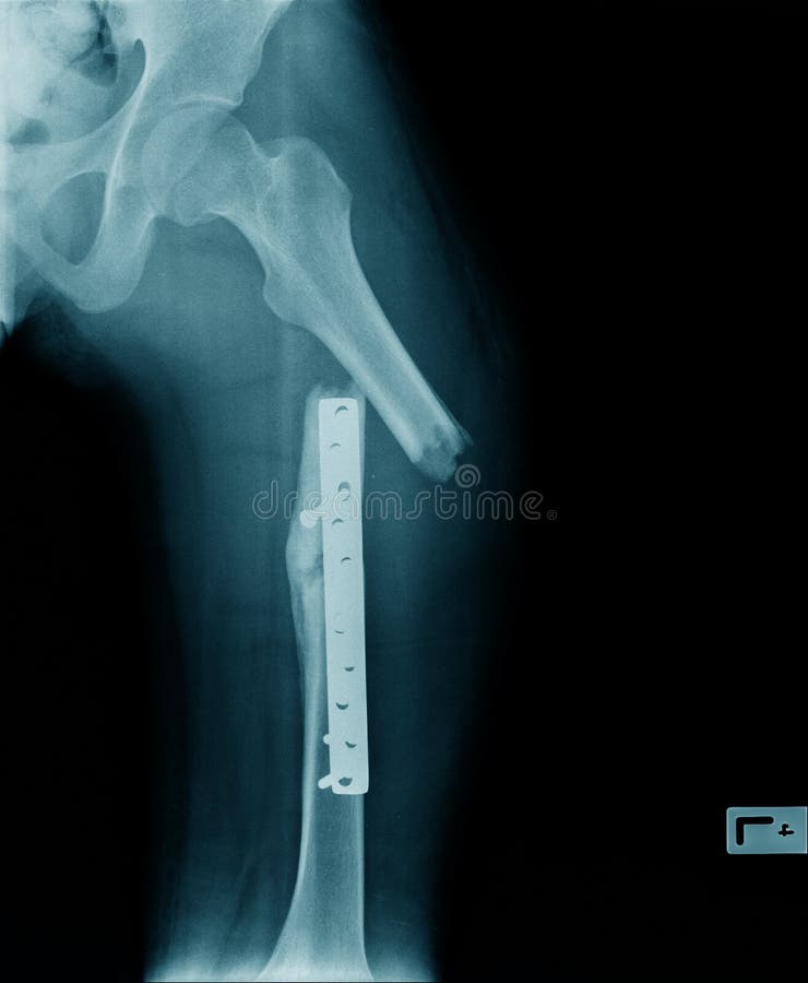 Fail plate of fumur bone fixation, x-ray femur bone with fail pate and fixation device. Fail plate of fumur bone fixation, x-ray femur bone with fail pate and fixation device