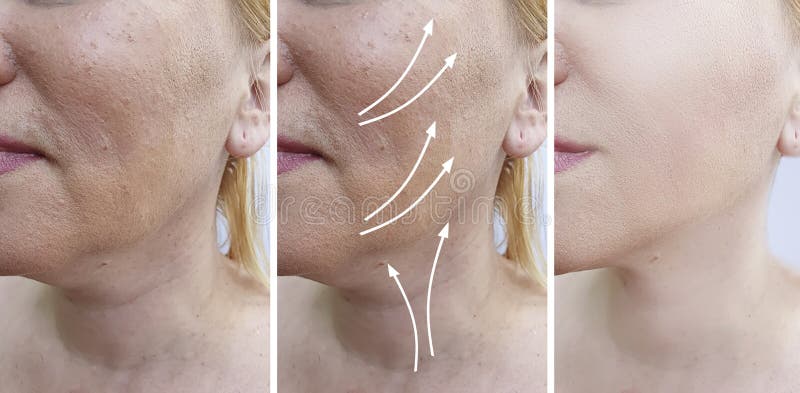 Woman double chin before and after treatment tightening  facelift. Woman double chin before and after treatment tightening  facelift