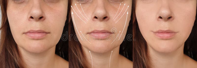 Woman face lift before and after treatment  effect    correction difference. Woman face lift before and after treatment  effect    correction difference