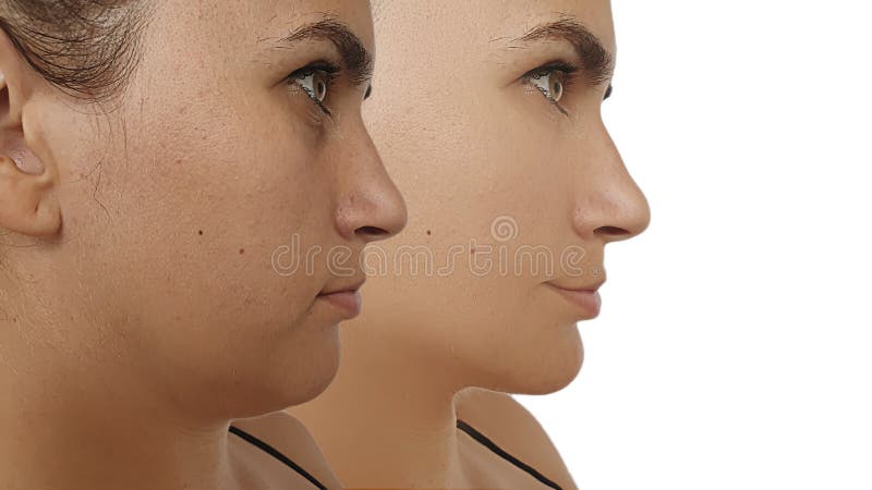 Woman double chin aesthetic  before and after treatment facelift correction. Woman double chin aesthetic  before and after treatment facelift correction