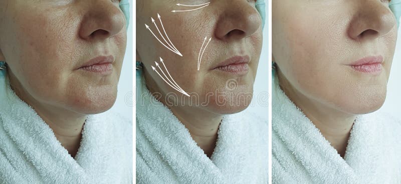 woman face wrinkles before and after treatment collage arrow thread liftingn. woman face wrinkles before and after treatment collage arrow thread liftingn