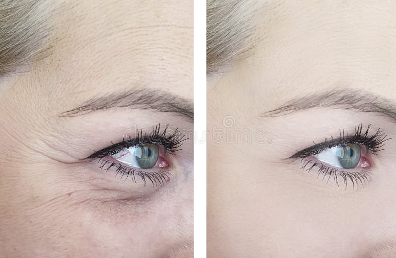L'occhio femminile si corruga prima dopo le procedure mature di correzione di cosmetologia dell'ascensore di differenza di effett