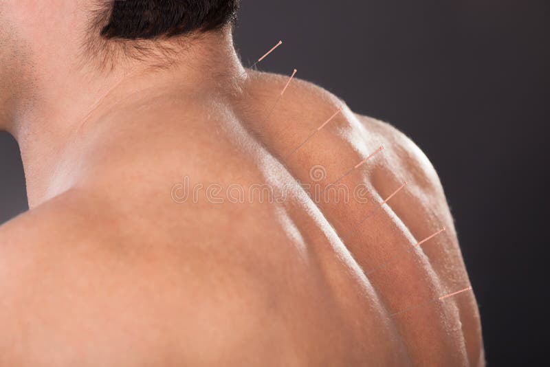 L'uomo con gli aghi di agopuntura sopra appoggia fotografia stock L'uomo con gli aghi di agopuntura sopra appoggia fotografia stock