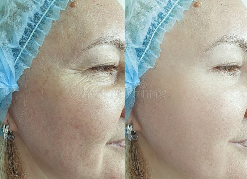 Old woman wrinkles eyes before and after treatment revitalization results removal. Old woman wrinkles eyes before and after treatment revitalization results removal