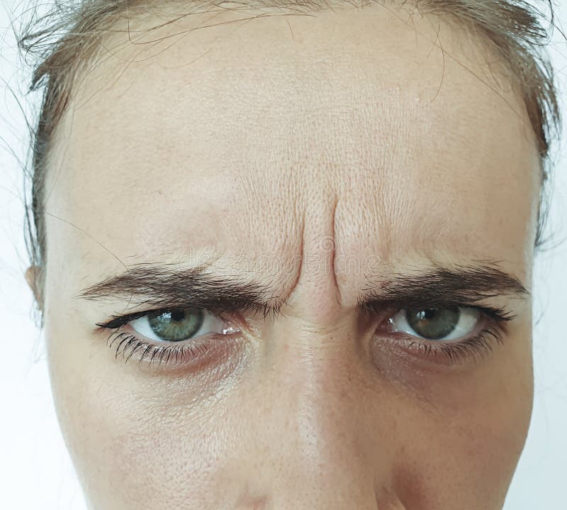 La Cara De La Mujer Arruga La Frente Del Tratamiento Foto De Archivo