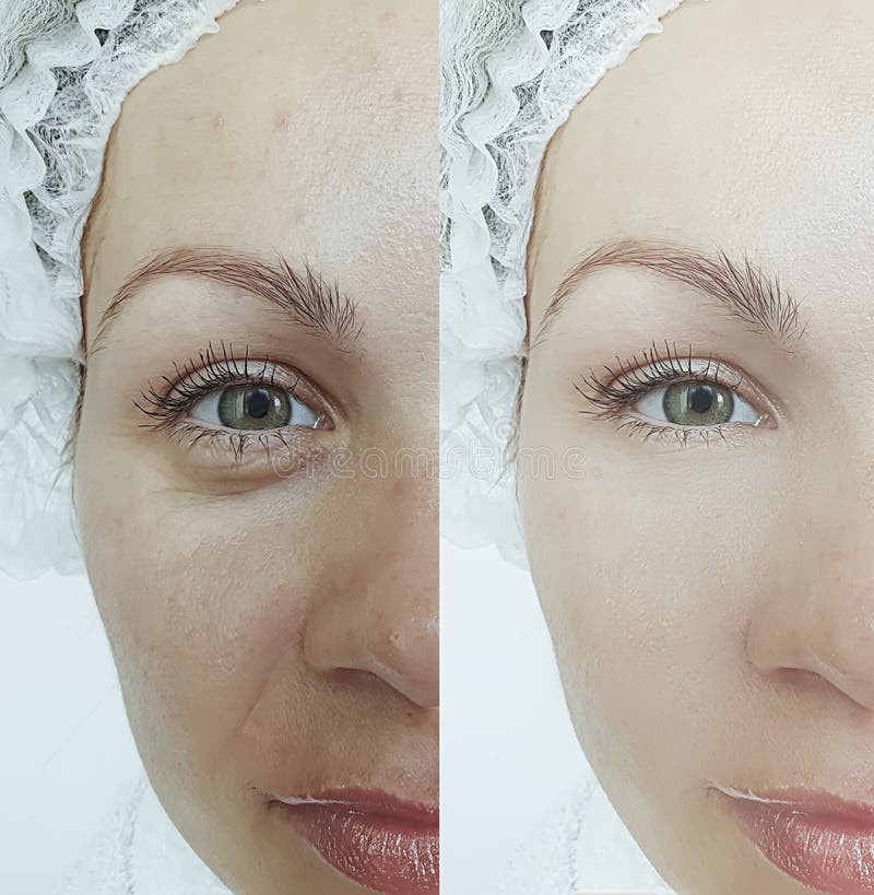 Woman eyes removal  swollen  wrinkles before and after treatment revitalization   difference antiaging therapy regeneration lifting. Woman eyes removal  swollen  wrinkles before and after treatment revitalization   difference antiaging therapy regeneration lifting