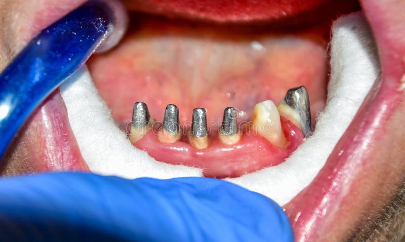 La fabricación de prótesis dentales, las coronas matálicas-cerámicas en los dientes del yeso modela en el tratamiento de paciente foto de archivo La fabricación de prótesis dentales, las coronas matálicas-cerámicas en los dientes del yeso modela en el tratamiento de paciente foto de archivo
