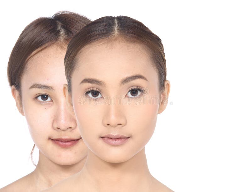 Nez Femelle Avant Et Apres La Chirurgie Esthetique Photo Stock Image Du Chirurgien Verticale Nez Femelle Avant Et Apres La Chirurgie Esthetique Photo Stock Image Du Chirurgien Verticale