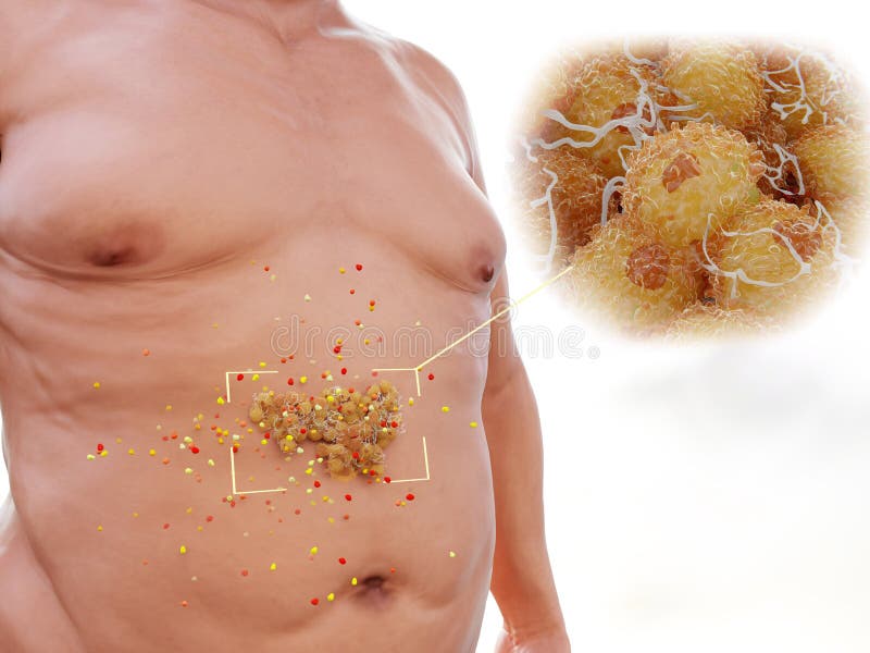 3d computer illustration of visceral fat. Visceral fat describes the fat that accumulates in the abdominal cavity enveloping the internal organs, mostly those of the digestive system. It is highly hormonally active and increases the risk for coronary heart disease, cancer, stroke, dementia, diabetes, depression, arthritis, thrombosis, obesity, sexual dysfunction, sleep disorde. 3d computer illustration of visceral fat. Visceral fat describes the fat that accumulates in the abdominal cavity enveloping the internal organs, mostly those of the digestive system. It is highly hormonally active and increases the risk for coronary heart disease, cancer, stroke, dementia, diabetes, depression, arthritis, thrombosis, obesity, sexual dysfunction, sleep disorde