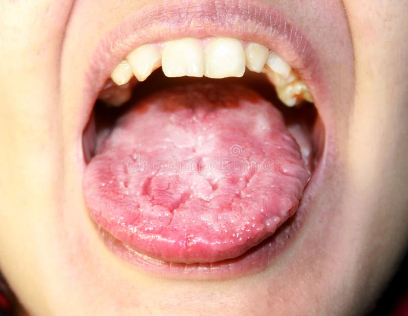 Mancha Roja En La Lengua La Lengua Está En Una Incursión Blanca Candidiasis En La Lengua Imagen