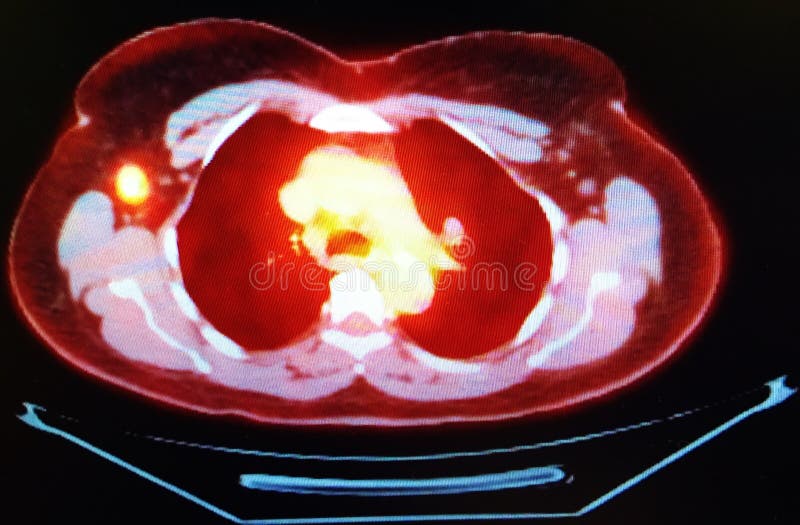 PET/CT tomography scan revealed breast oncological pathology . Yellow spot in the left middle part of the image is right axillary lymph node regional metastatic disease. PET/CT tomography scan revealed breast oncological pathology . Yellow spot in the left middle part of the image is right axillary lymph node regional metastatic disease.