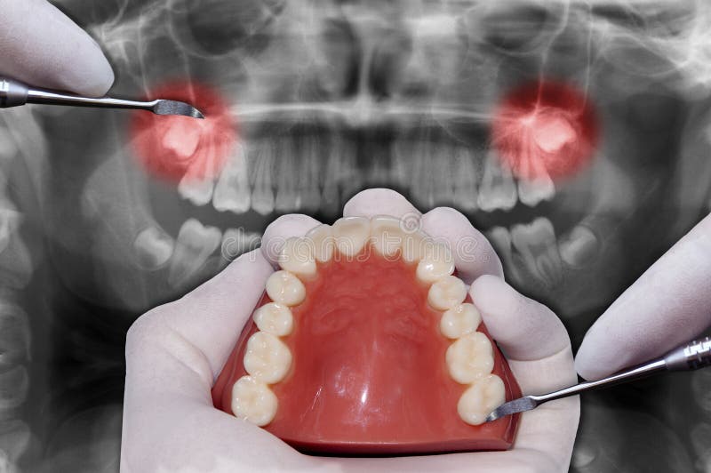 La mano del dentista simula cirugía dental
