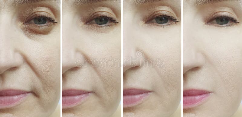 Woman face wrinkles before and after treatment collage revitalization  difference antiaging result dermatology collagen. Woman face wrinkles before and after treatment collage revitalization  difference antiaging result dermatology collagen