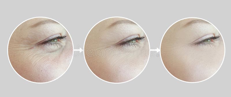 Woman face wrinkles before and after treatment collage revitalization therapy difference antiaging. Woman face wrinkles before and after treatment collage revitalization therapy difference antiaging