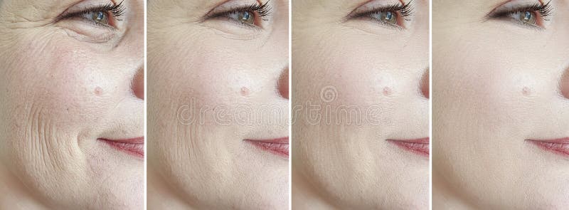 Woman face wrinkles before and after treatment collage revitalization therapy difference antiaging result. Woman face wrinkles before and after treatment collage revitalization therapy difference antiaging result