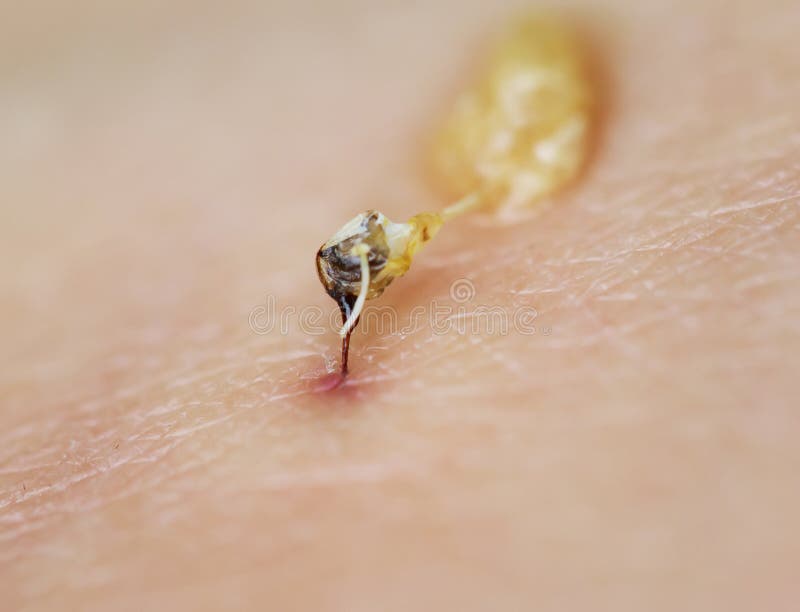 La picadura de abeja aguda con un bolso del veneno rompió la piel fotografía de archivo La picadura de abeja aguda con un bolso del veneno rompió la piel fotografía de archivo