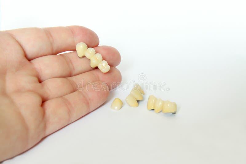 La porcellana incorona, getta un ponte su (odontoiatria), zolla dentale immagine stock libera da diritti La porcellana incorona, getta un ponte su (odontoiatria), zolla dentale immagine stock libera da diritti