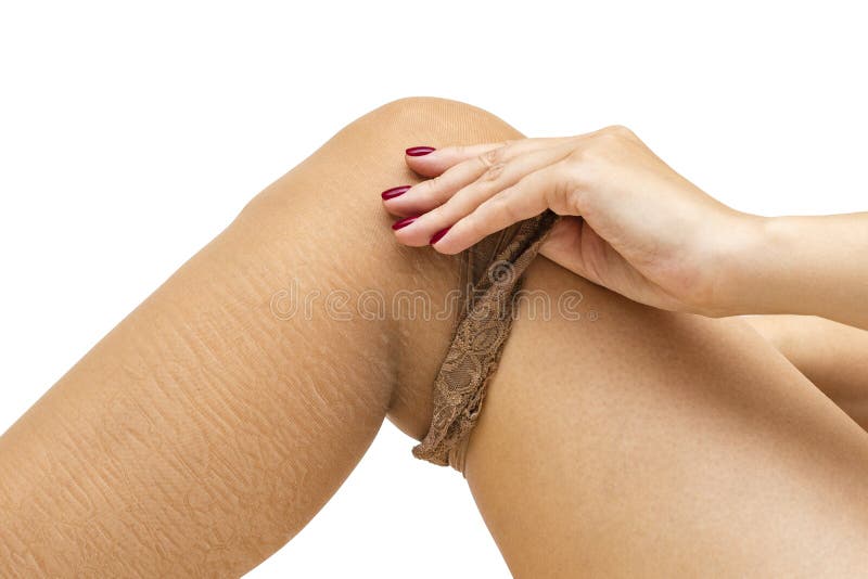 La ragazza decolla il suo collant con pelle asciutta Crepe nella pelle delle gambe fotografia stock libera da diritti La ragazza decolla il suo collant con pelle asciutta Crepe nella pelle delle gambe fotografia stock libera da diritti