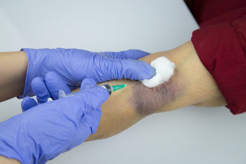 Arm With Injection Bruises And Hospital Wristband Stock Image Image