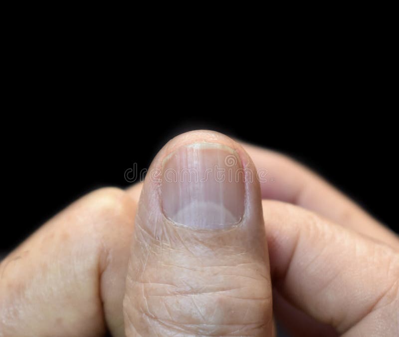 Spotted a red half moon on your nail? Could be a sign of Covid-19. Read  here to know more | Mint