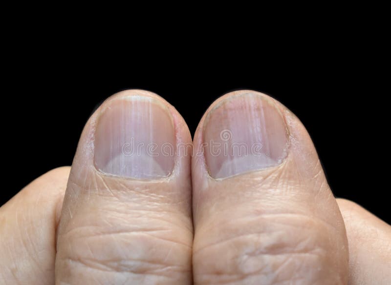 Vertical lines on the nails (1)#verticalline #nails #fingers #tiktok #... |  TikTok