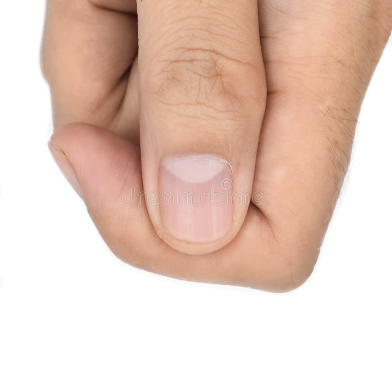 15 Fingernail and Toenail Abnormalities