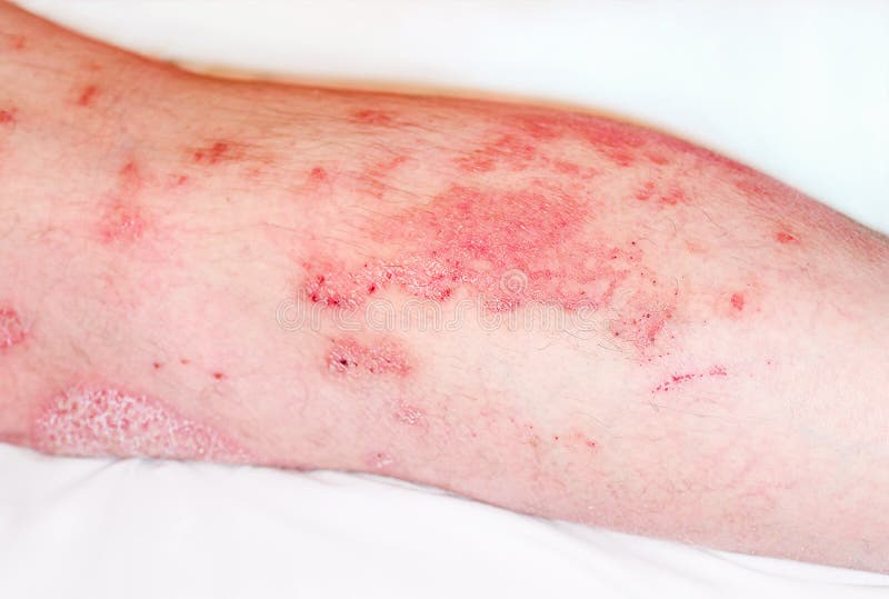 Large Redinflamedscaly Rash On Man S Legsacute Psoriasis Severe