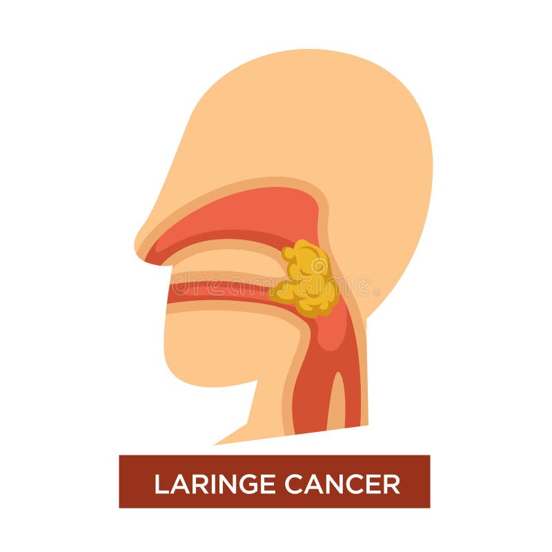 Laringe Cancer Illness Malignant Tumor in Throat Stock Vector -  Illustration of medical, growth: 137452741
