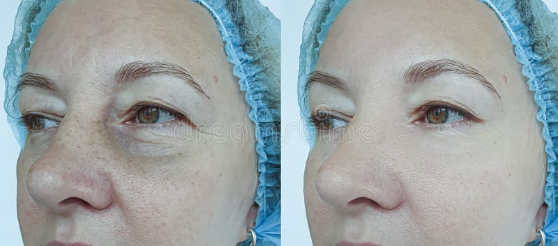 Elderly woman face wrinkles removal before and after treatment  effect difference tension revitalization lifting. Elderly woman face wrinkles removal before and after treatment  effect difference tension revitalization lifting