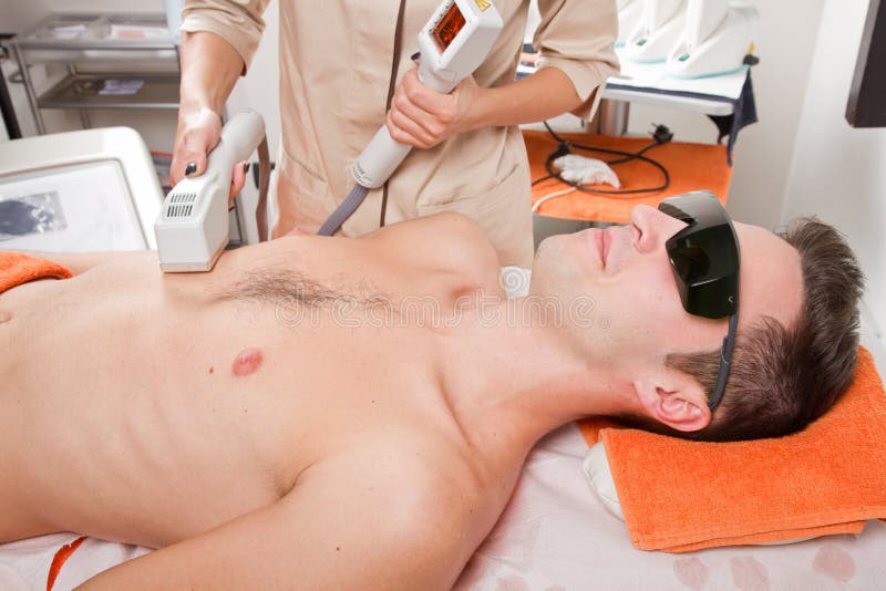 laser epilation