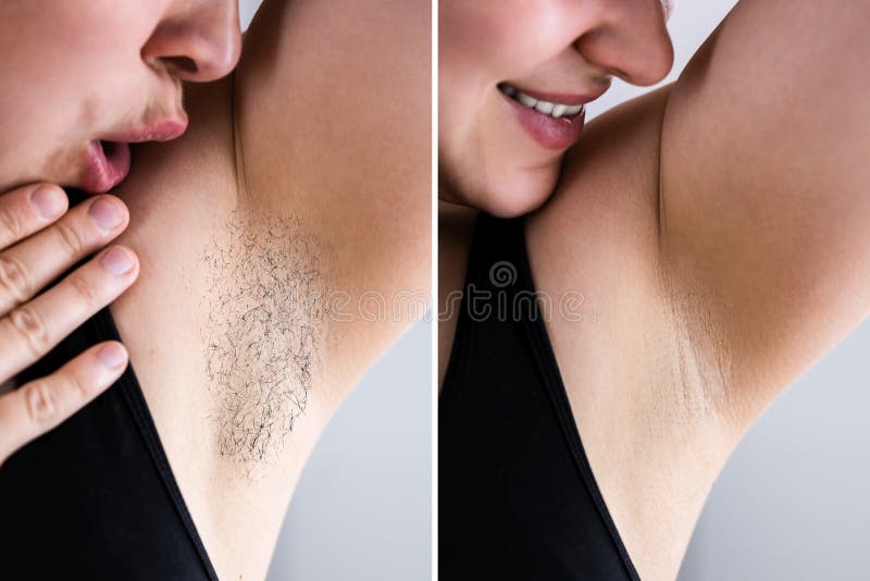 Before after Laser Hair Removal Stock Image - Image of depilation, hair:  218665307
