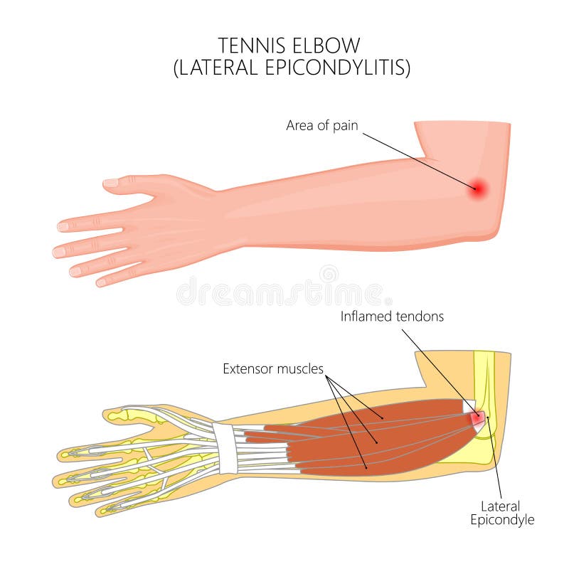Lateral Epicondylitis lub tenisowy łokieć ilustracja wektor Lateral Epicondylitis lub tenisowy łokieć ilustracja wektor