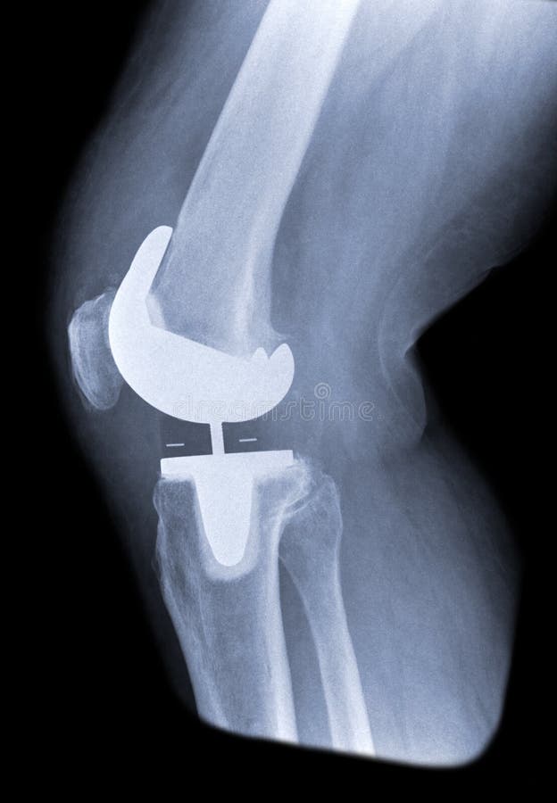 Lato totale del rimontaggio del ginocchio
