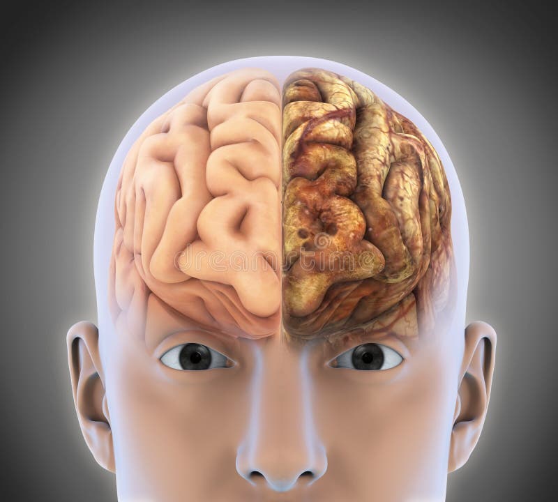 Le cerveau sain et le cerveau malsain illustration libre de droits Le cerveau sain et le cerveau malsain illustration libre de droits