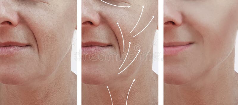 Le grinze del fronte della pelle della donna effettuano la correzione invecchiante prima e dopo le procedure, freccia di risultat