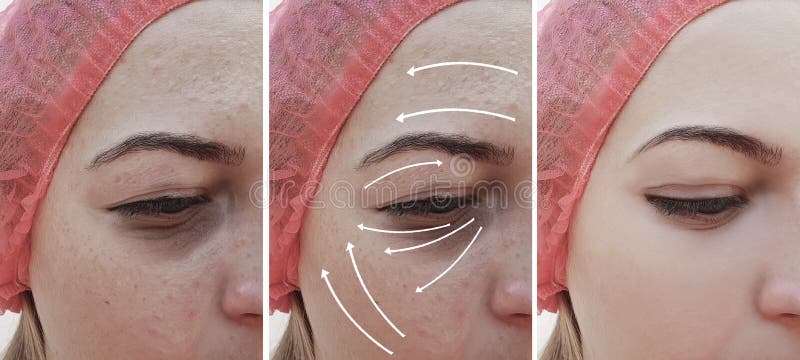 Le grinze della donna affrontano prima e dopo la correzione di terapia, freccia fotografia stock Le grinze della donna affrontano prima e dopo la correzione di terapia, freccia fotografia stock
