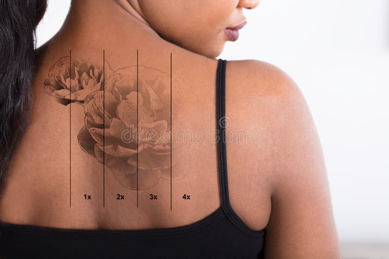 Le laser tatouent le retrait sur le ` s de femme de retour photo libre de droits Le laser tatouent le retrait sur le ` s de femme de retour photo libre de droits