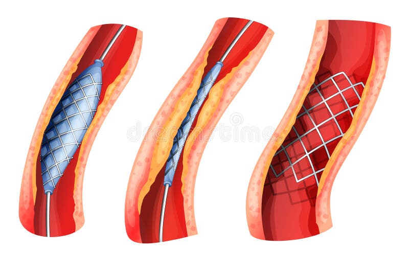 Le Stent employé pour s'ouvrir a bloqué l'artère illustration stock Le Stent employé pour s'ouvrir a bloqué l'artère illustration stock