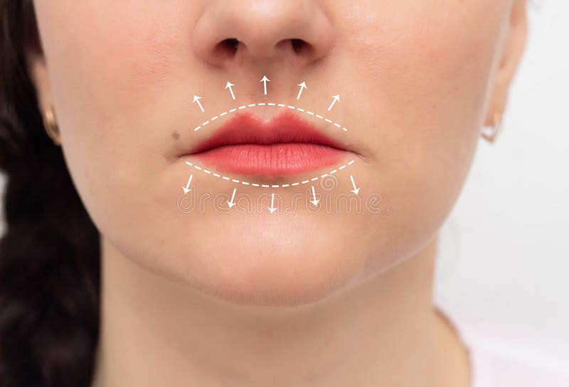 Girl`s face with painted lips and white markers on the lips. The concept of lip augmentation using contouring and cannulas. Girl`s face with painted lips and white markers on the lips. The concept of lip augmentation using contouring and cannulas