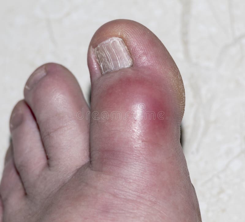 pix Pictures Of Gout In Big Toe dreamstime com