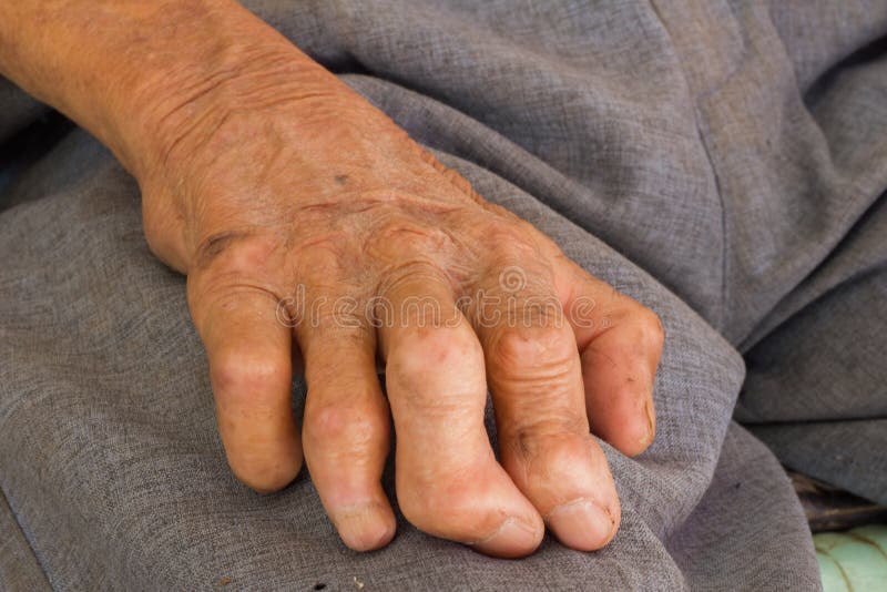 Left hand of a leprosy stock photos