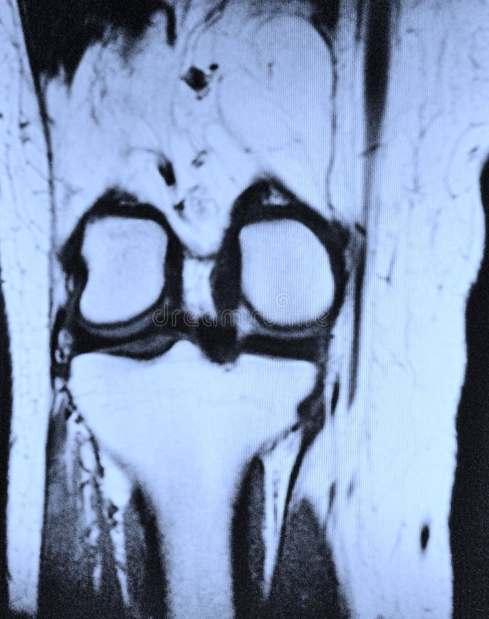 Left knee mri stock photo. Image of knee, structures - 46287880